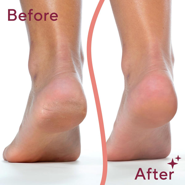 Smooth Steps Callus Remover